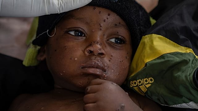 First-ever mpox cases reported in Guinea-Bissau with children the most vulnerable